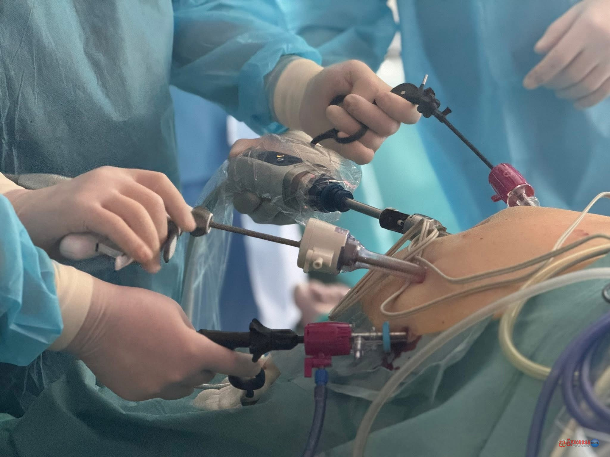 У Чернівцях уперше виконали складну лапароскопічну операцію при раку підшлункової залози